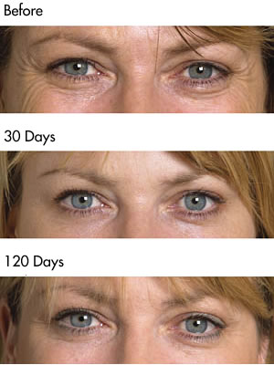 Botulinum Toxin crows feet before and after photos