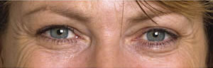 Crows feet before Botulinum Toxin treatment