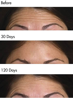 Botulinum Toxin forehead lines before and after photos