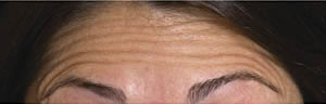 Forehead lines before Botulinum Toxin treatment