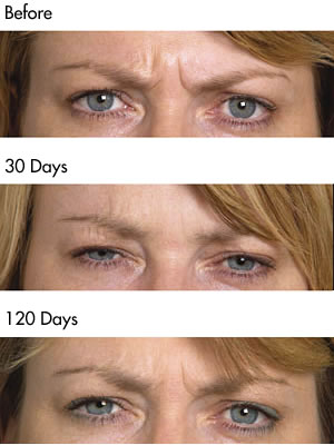 Botulinum Toxin frown lines  before and after photos
