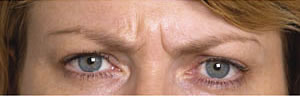 Frown lines before Botulinum Toxin treatment