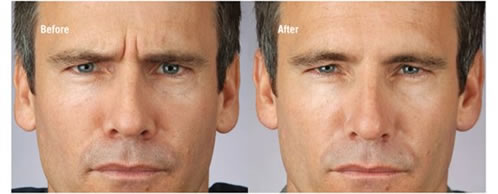 Botulinum Toxin for Men Before and After Treatment