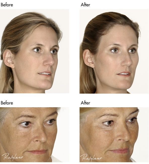 Facial Fillers Before and After - Cheek Filler
