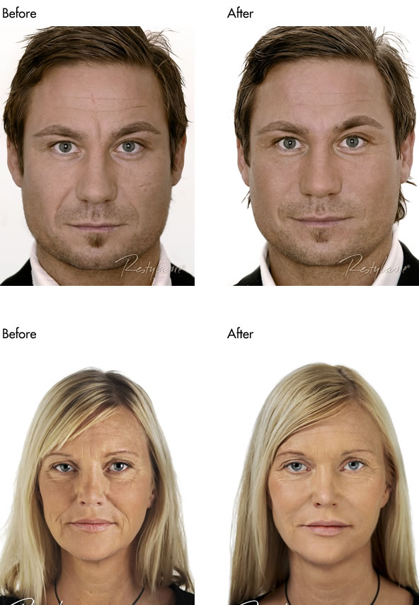 Facial Fillers Before and After - Full Face Male and Female