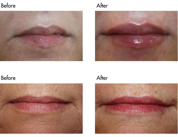 Facial Fillers Before and After - Lip Filler