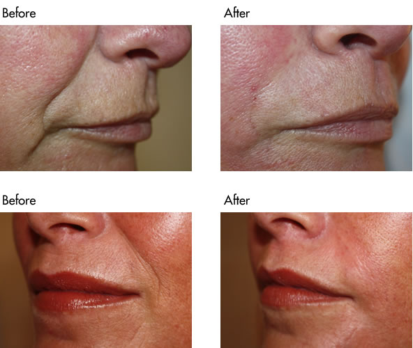 Facial Fillers Before and After - Nasolabial Lines