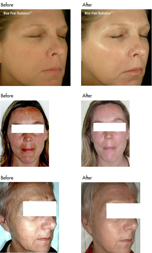 Facial Peels Before and After