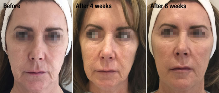 Profhilo treatment dublin before and after photos