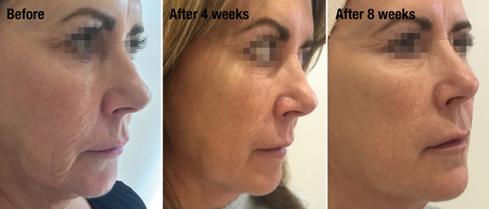 Profhilo treatment dublin before and after photos