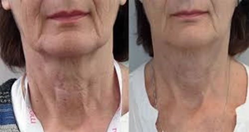 Profhilo treatment dublin before and after photos